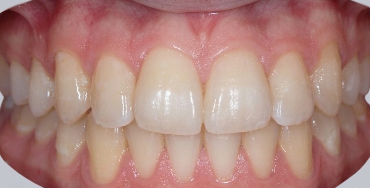 Vivid Smiles patient case 8 before and after treatment comparison after